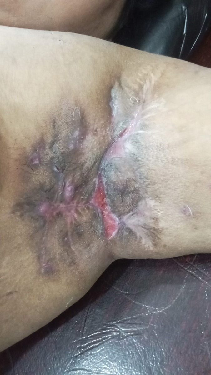 Hidradenitis suppurativa clinical photograph, Month 6