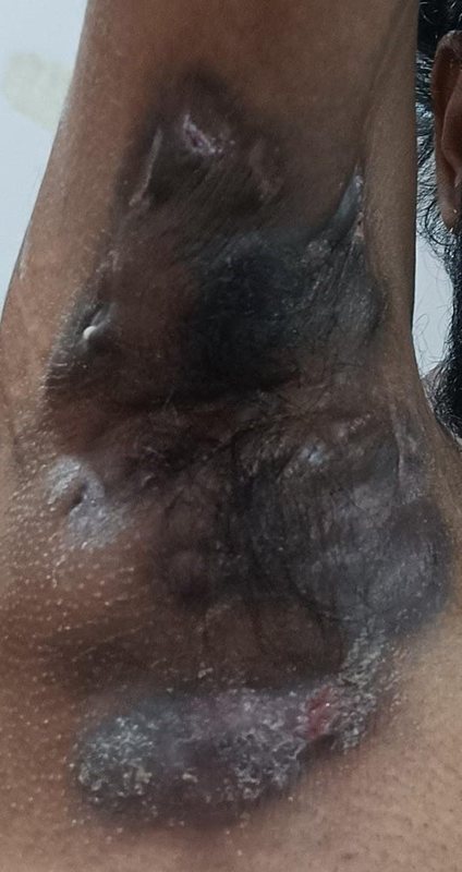 Hidradenitis suppurativa clinical photograph