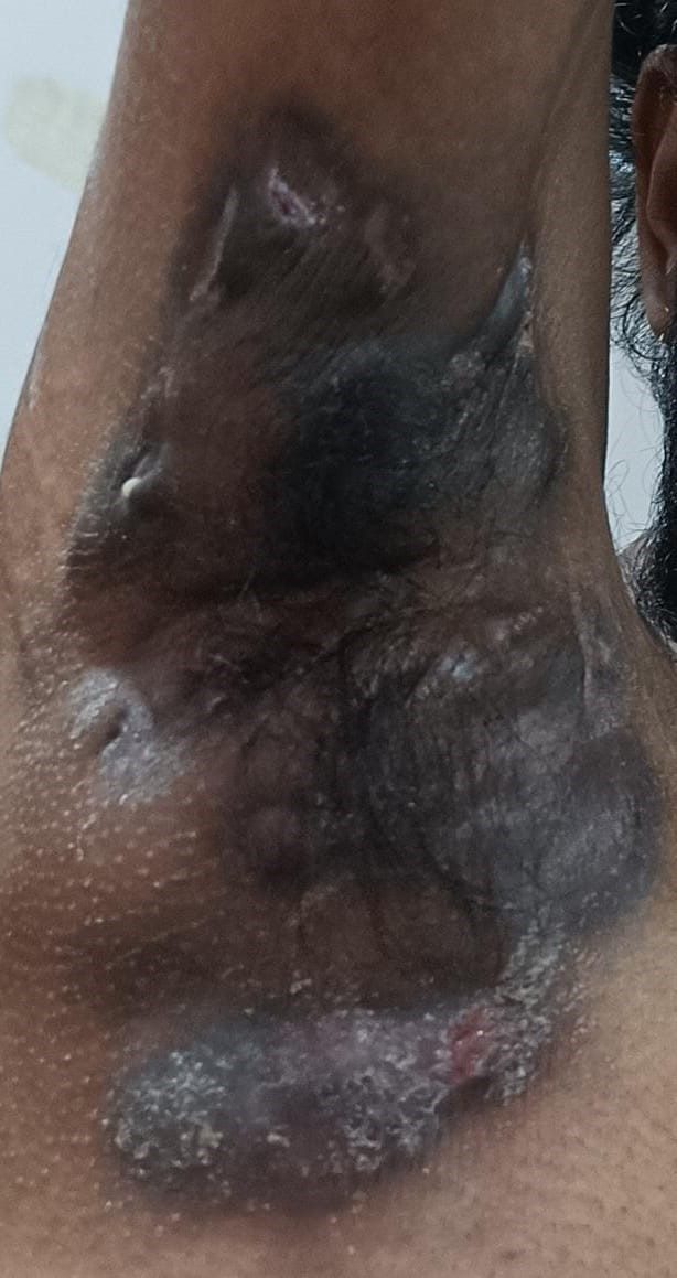 Hidradenitis suppurativa clinical photograph, Baseline
