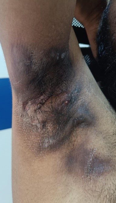 Hidradenitis suppurativa clinical photograph, Month 3