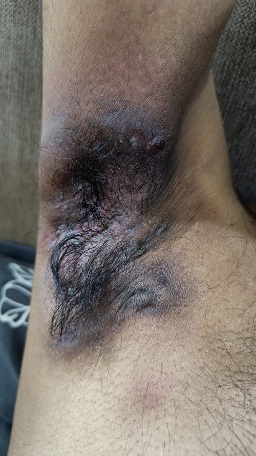 Hidradenitis suppurativa clinical photograph, Month 6