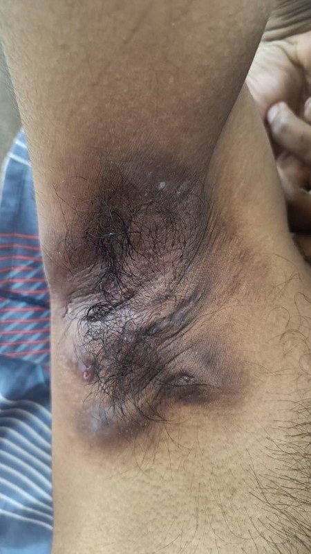 Hidradenitis suppurativa clinical photograph