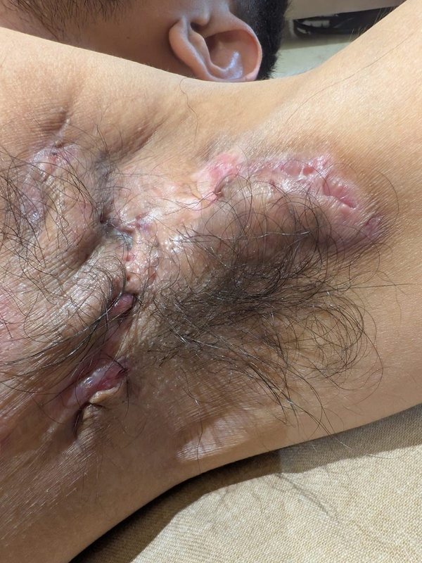 Hidradenitis suppurativa clinical photograph