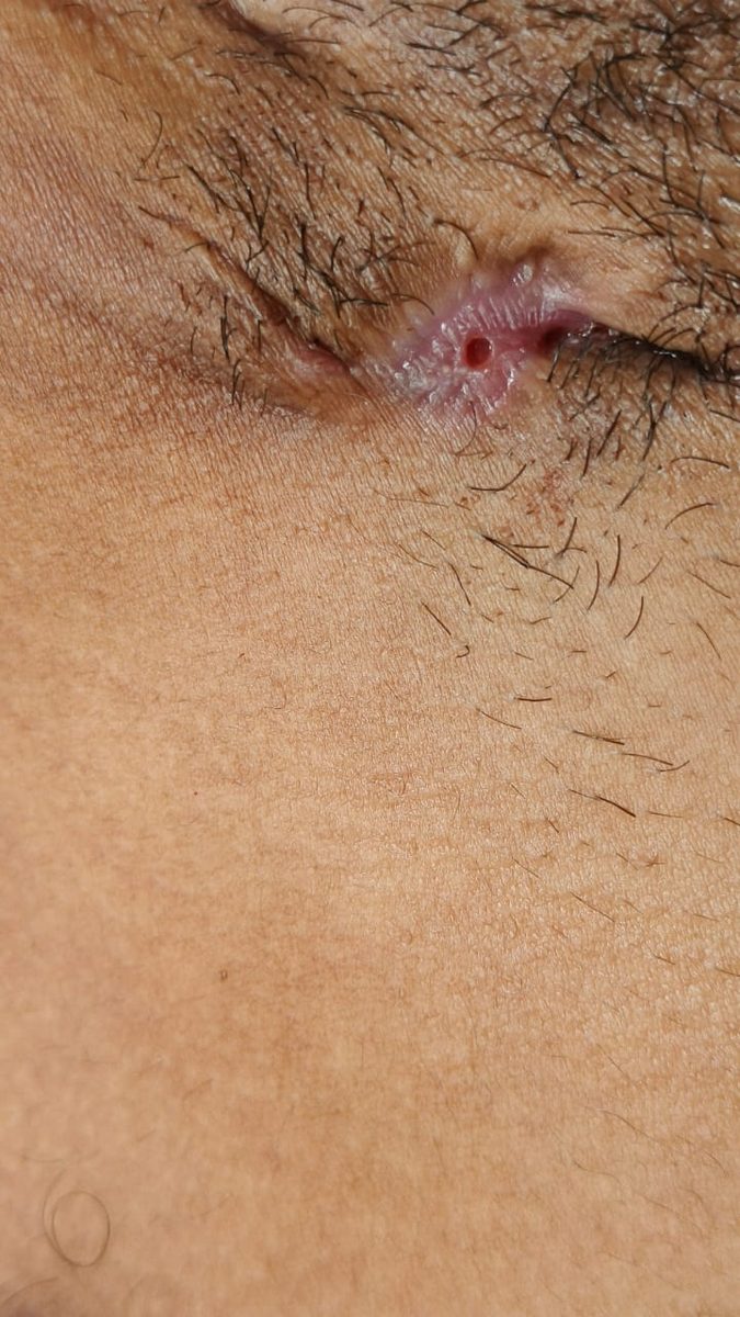 Hidradenitis suppurativa clinical photograph, Month 2
