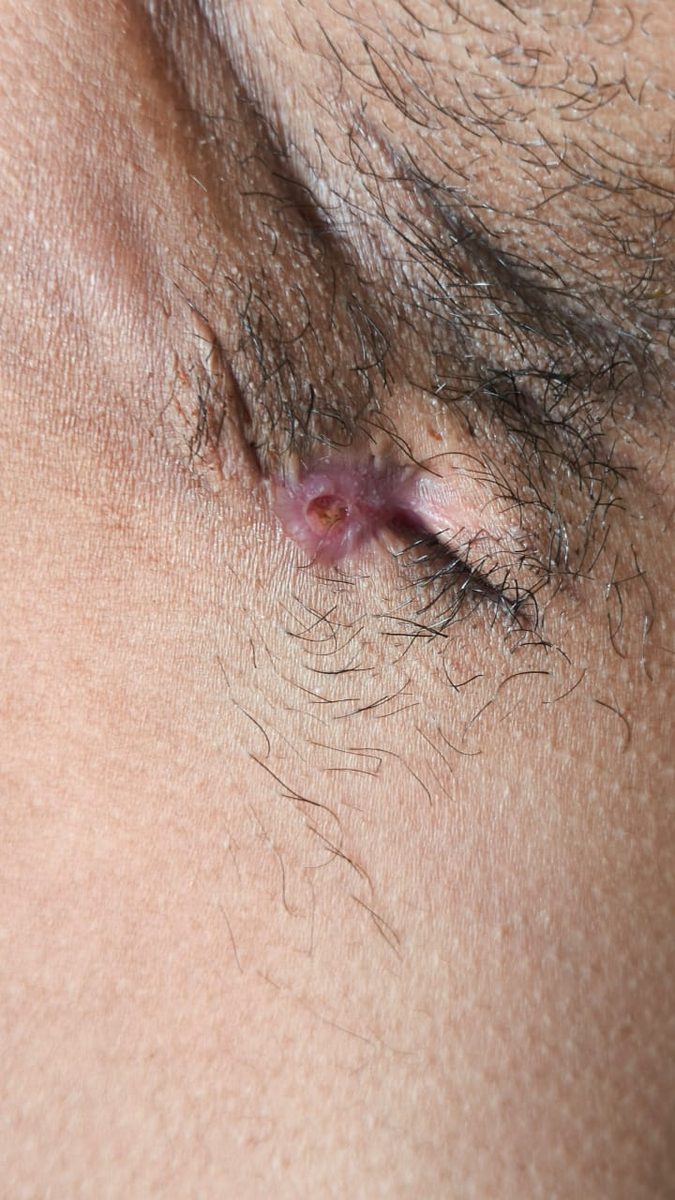 Hidradenitis suppurativa clinical photograph, Month 3