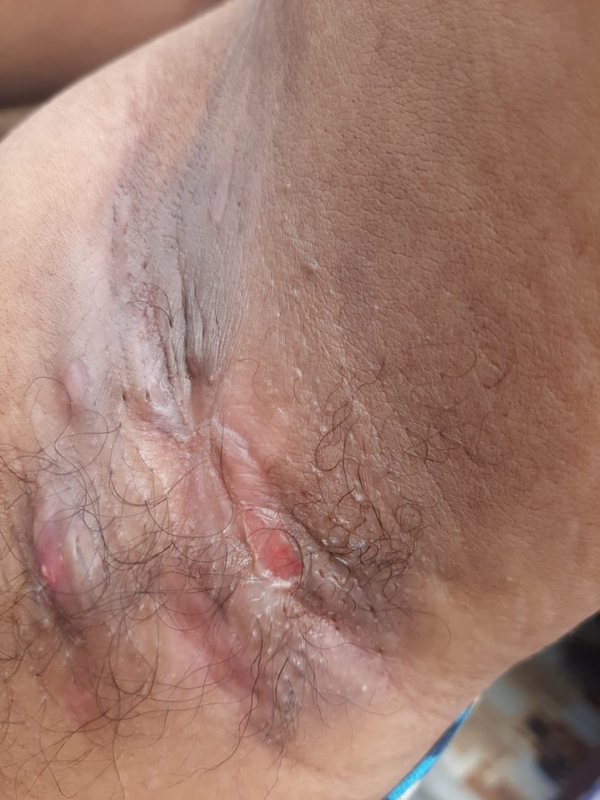 Hidradenitis suppurativa clinical photograph