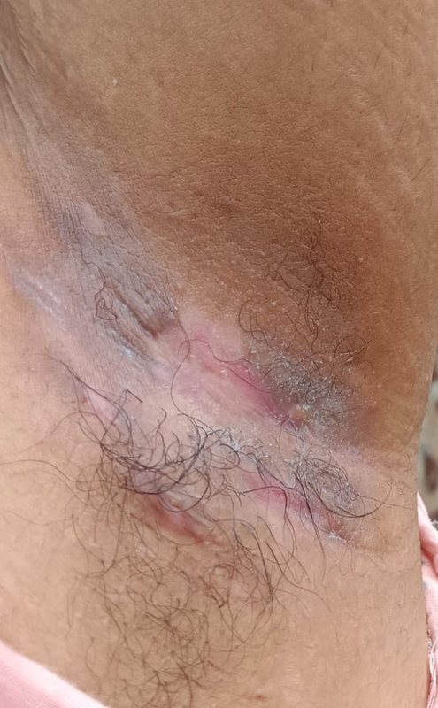 Hidradenitis suppurativa clinical photograph