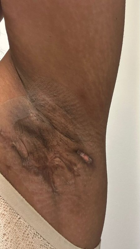 Hidradenitis suppurativa clinical photograph