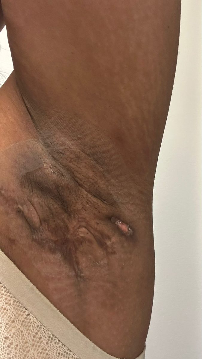 Hidradenitis suppurativa clinical photograph, Baseline · left