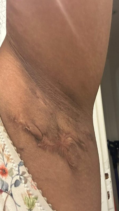 Hidradenitis suppurativa clinical photograph