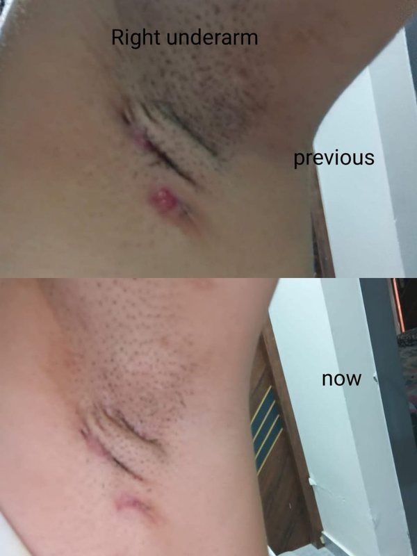 Hidradenitis suppurativa clinical photograph