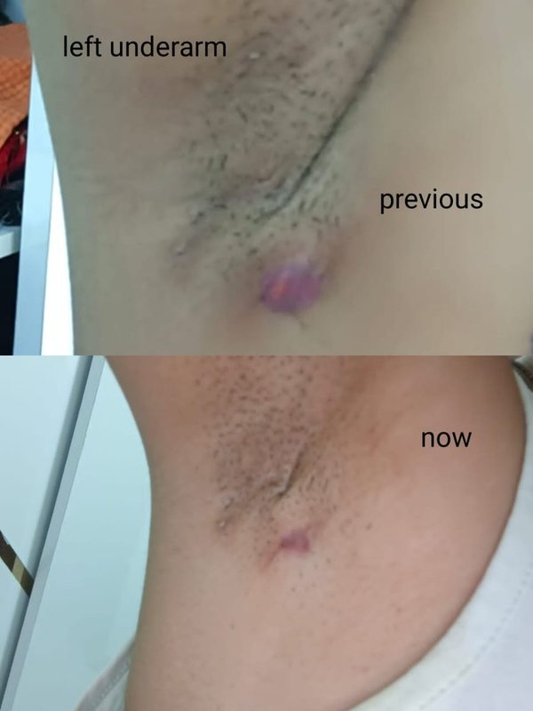 Hidradenitis suppurativa clinical photograph