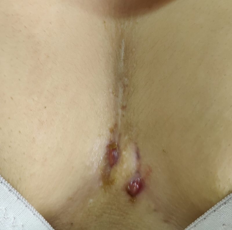 Hidradenitis suppurativa clinical photograph